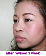 plastic_surgery_augmentation_rhinoplasty